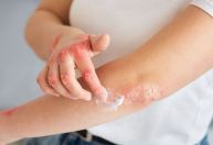 Síndrome rara ligada a pomadas com corticoide intriga médicos