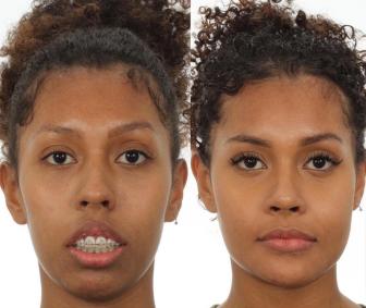 Antes e depois de cirurgia de Giovanna Jacobina
