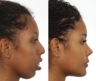 Antes e depois de cirurgia de Giovanna Jacobina