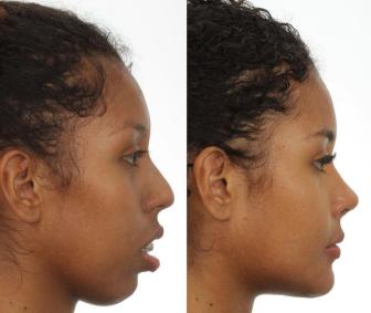 Antes e depois de cirurgia de Giovanna Jacobina