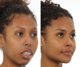 Antes e depois de cirurgia de Giovanna Jacobina