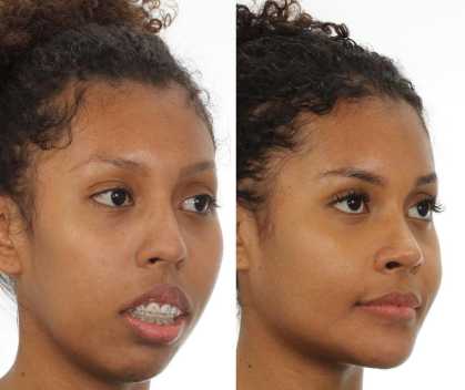 Antes e depois de cirurgia de Giovanna Jacobina
