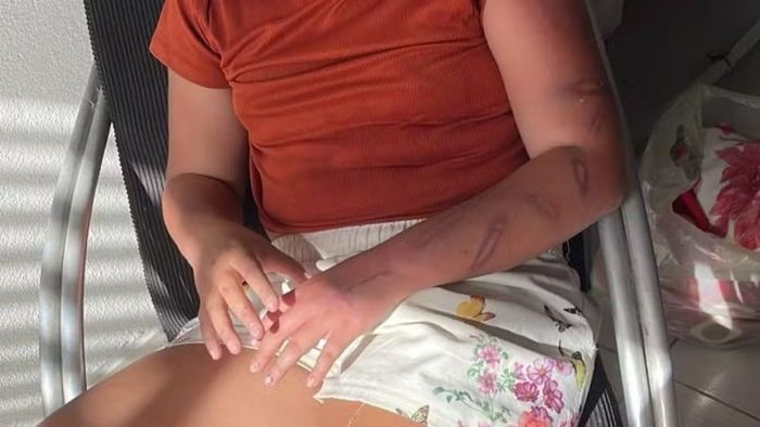 Foto mostra marcas de agressão em criança de 11 anos