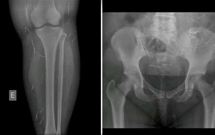 Conselho Tutelar levou a mulher para hospital onde foram feitos exames que constataram diversas agulhas pelo corpo dela. Conselho Tutelar levou a mulher para hospital onde foram feitos exames que constataram diversas agulhas pelo corpo dela.