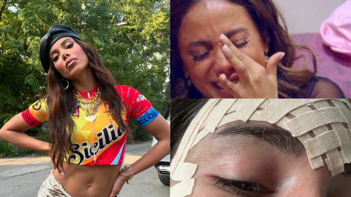 Anitta retira veias da testa e detalha procedimento: 'Fim de uma era'