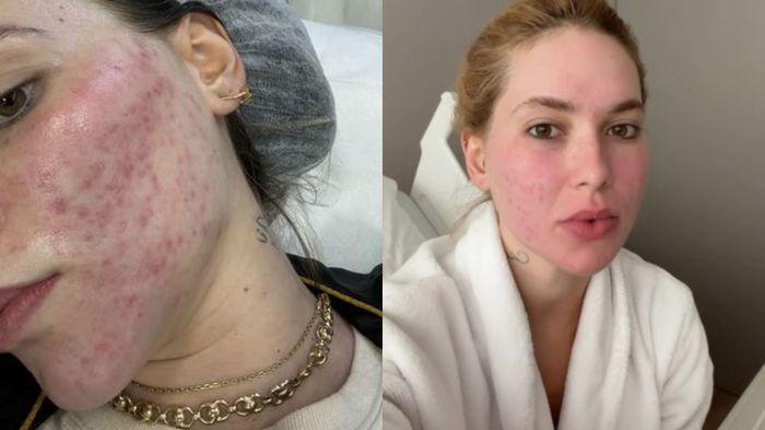 Virginia passa por procedimento estético 