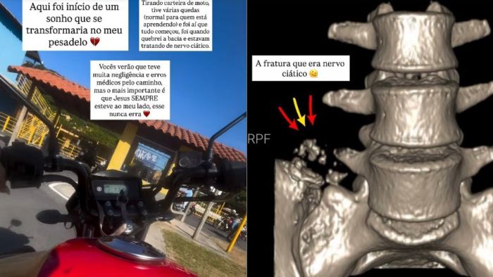 Mineira mostrou como foi a fratura e como o processo sobre tirar a carteira de moto virou um 