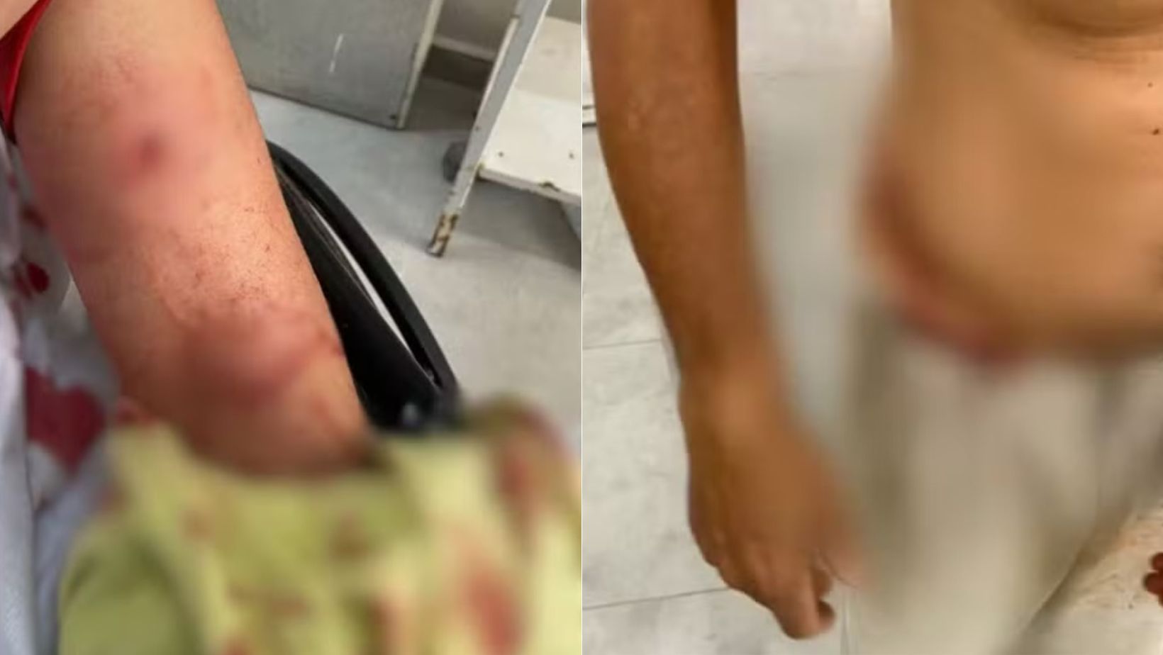 Jovem é atacada por pit bulls, homem tenta ajudar e também é ferido
