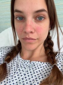 Barbara Palvin passou por cirurgia para tratar a doença