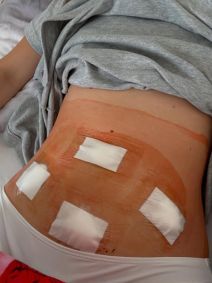 Barbara Palvin passou por cirurgia para tratar a doença