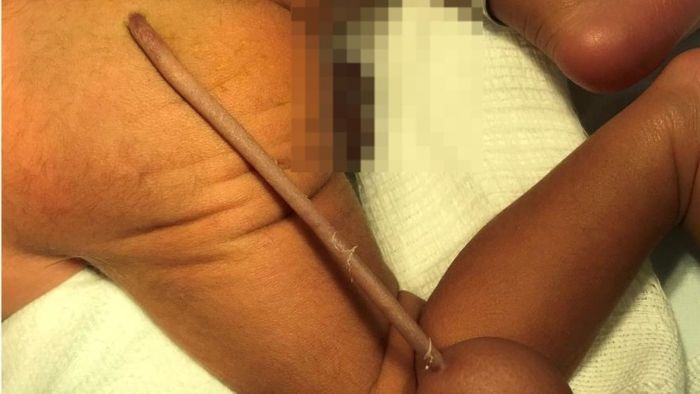 Foto mostra bebê que nasceu com cauda em Fortaleza (CE)