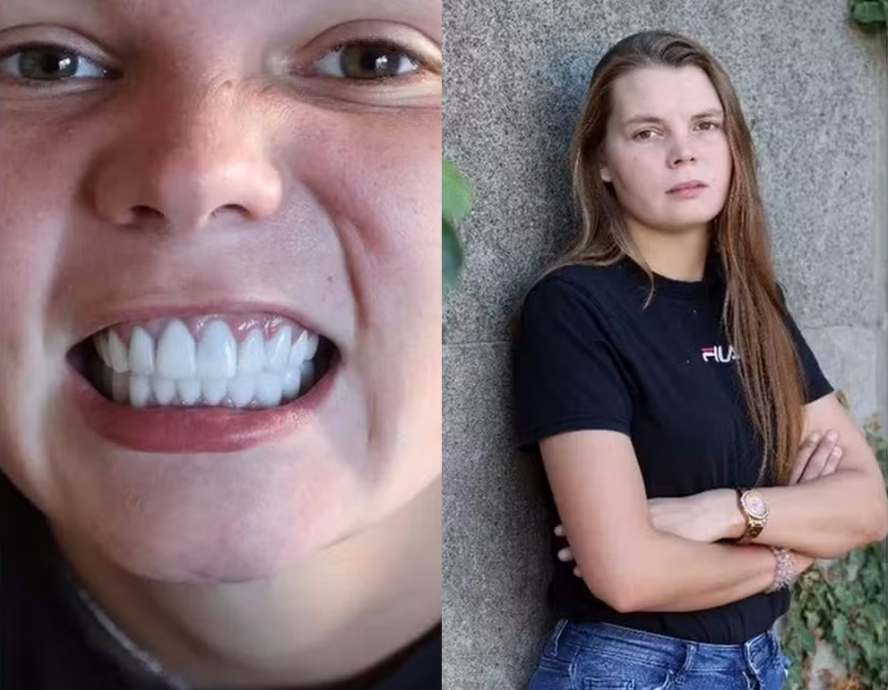 Belga perde todos dentes após gastar R$ 41 mil em tratamento dentário na Turquia