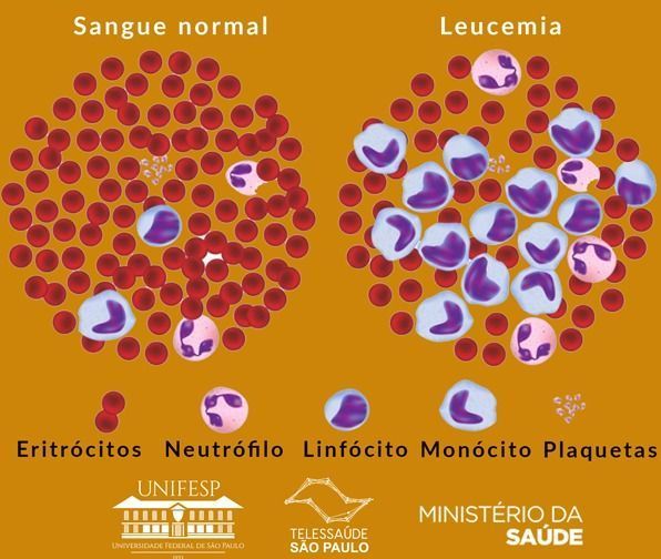 A Leucemia Mieloide Crônica (LMC) é um tipo de câncer que afeta a produção do sangue e a medula óssea.