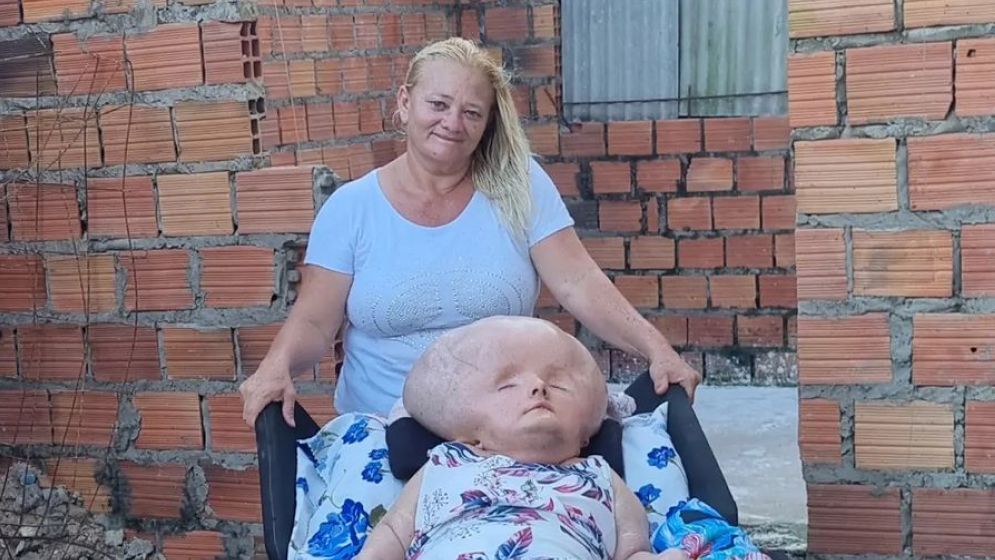Mãe de mulher com hidrocefalia gigante compartilha rotina com a filha e vive de ajudas