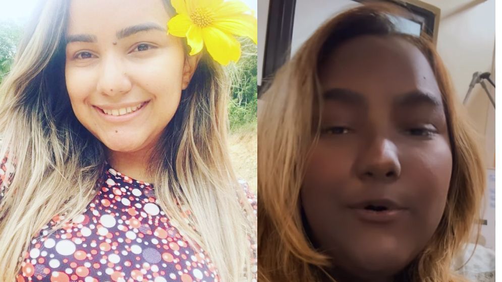 Jovem abandonou os estudos devido a tumor raro que causou mudança na cor da pele