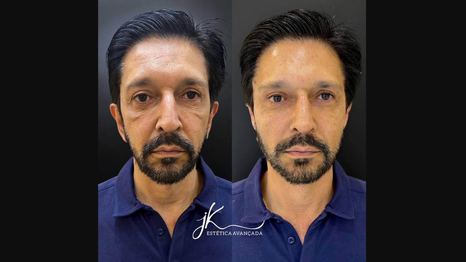 Ricardo Nunes, prefeito de São Paulo, faz harmonização facial; veja fotos do resultado