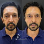 Ricardo Nunes, prefeito de São Paulo, faz harmonização facial; veja fotos do resultado