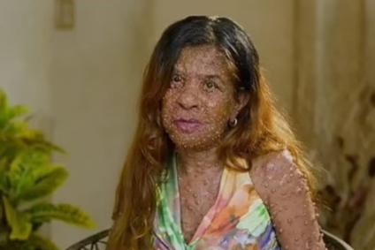 Charmaine Sahadeo, que tem condição rara chamada neurofibromatose NF-1