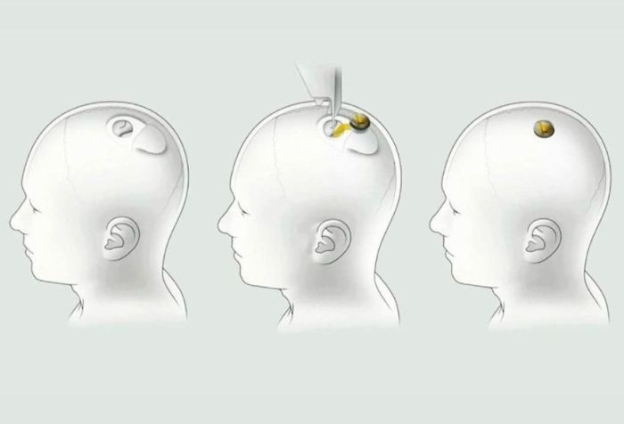 Neuralink faz demonstração com paciente que recebeu 1º implante de chip cerebral