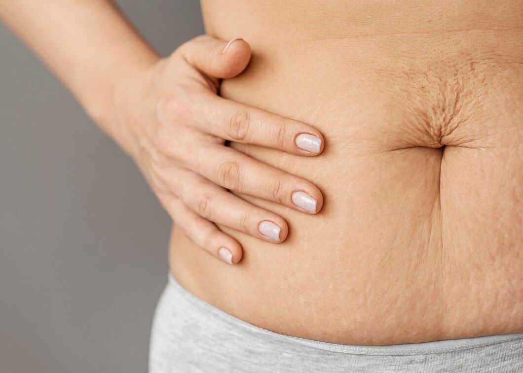 Luciana Pepino | Dez verdades que você precisa saber sobre pós-operatório da abdominoplastia