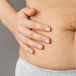 Luciana Pepino | Dez verdades que você precisa saber sobre pós-operatório da abdominoplastia