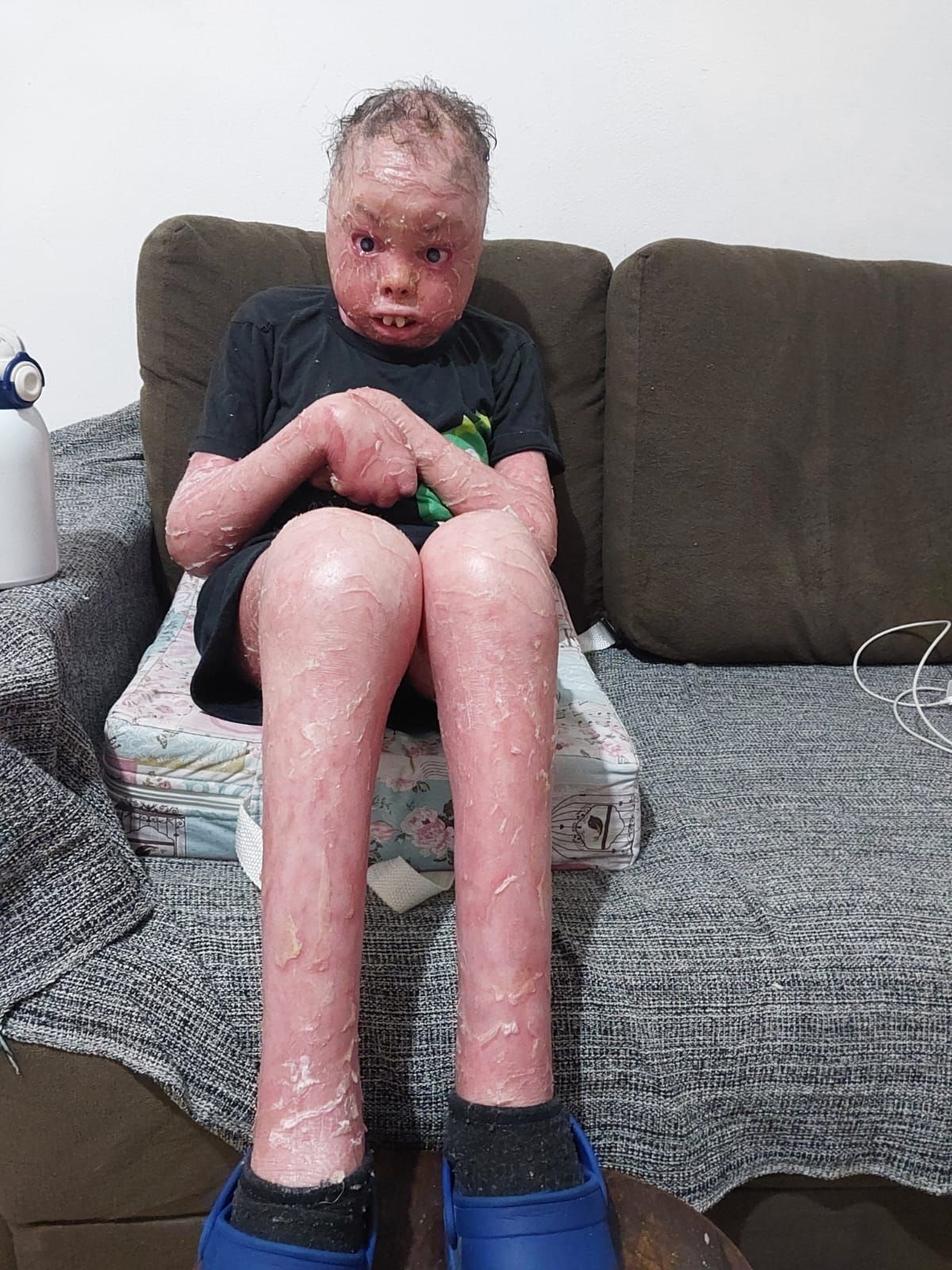 Com doença de pele rara e grave, menino de 12 anos faz vaquinha para custear tratamento na Grande BH