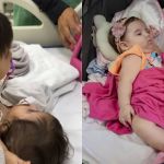 Siamesas unidas por tórax e abdomên passam por cirurgia para colocar expansores na pele