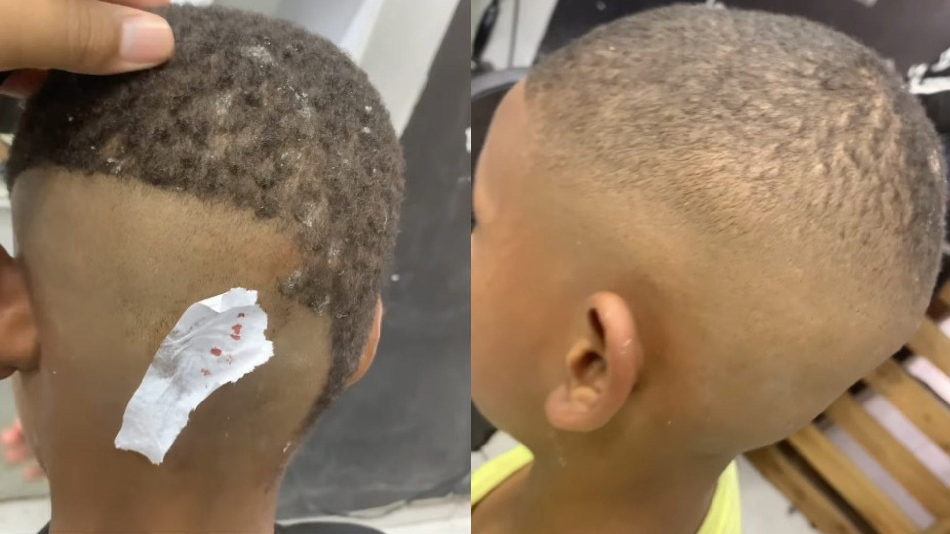 'Dia do Cabelo Maluco': barbeiro viraliza ao mostrar cabeça de criança com machucados causados por cola