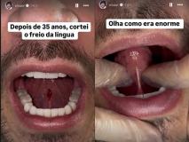Eliezer mostra recuperação após cirurgia na língua