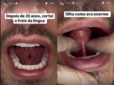 Eliezer mostra recuperação após cirurgia na língua