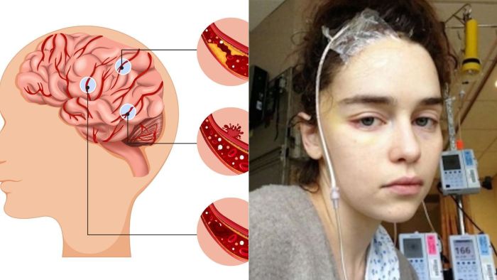 No caso da atriz Emilia Clarke, o aneurisma se rompeu. Em 2019, ele escreveu um ensaio para a revista The New Yorker onde revelou que sofreu uma hemorragia subaracnóidea.