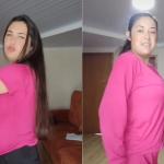 Estudante com doença rara faz cirurgia e retira 10 kg de mama no Paraná; veja fotos