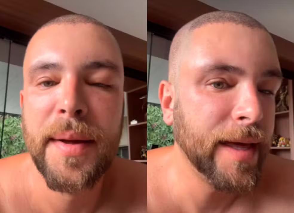 Transplante capilar: Gustavo Marsengo explica inchaço no rosto após cirurgia