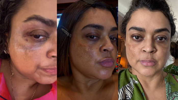 Preta Gil compartilhou fotos com as manchas no rosto pelo melasma