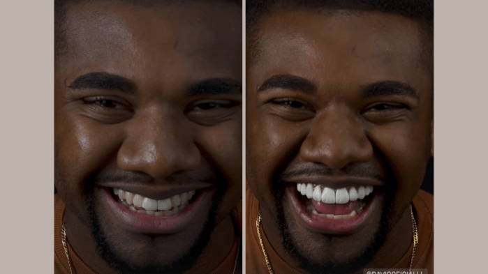 Davi Brito compartilha antes e depois de procedimento com lentes dentárias