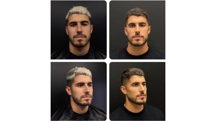 Pedro Raul, do Corinthians, fez procedimento facial com dermatologista de São Paulo