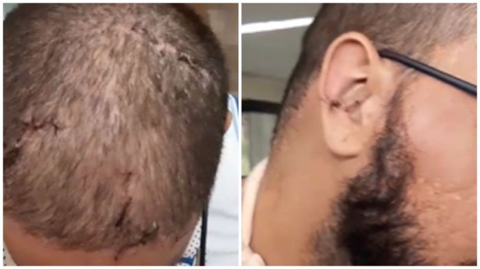 Torcedor identificado como Hugo deixou o Hospital João XIII com vários ferimentos na cabeça Torcedor identificado como Hugo deixou o Hospital João XIII com vários ferimentos na cabeça