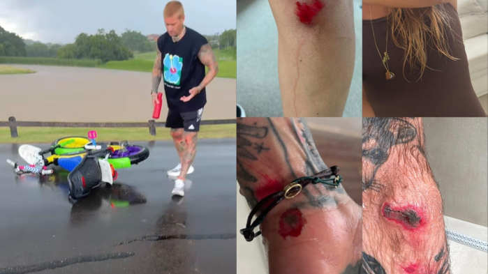 Shantal compartilha detalhes do acidente Shantal compartilha detalhes do acidente