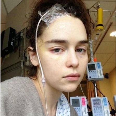 A atriz de 37 anos, sofreu ainda uma hemorragia subaracnóidea após um dos aneurismas.