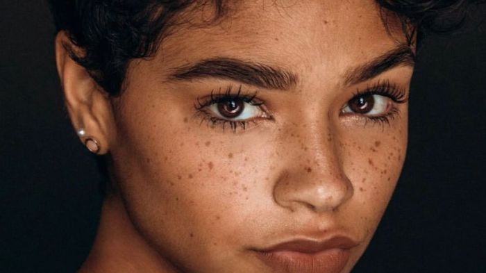 Hiperpigmentação em Peles Negras como prevenir e tratar manchas