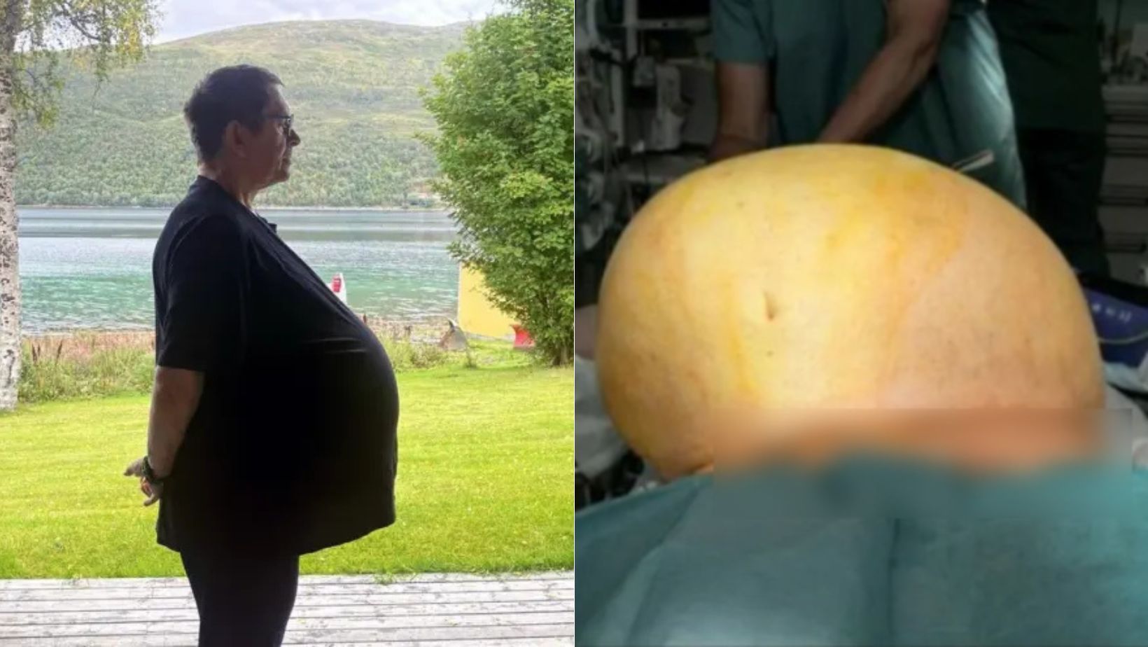 Homem considerado 'obeso' e que se tratava com ozempic descobre tumor de 27 kg; veja antes e depois