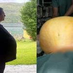 Homem considerado 'obeso' e que se tratava com ozempic descobre tumor de 27 kg; veja antes e depois