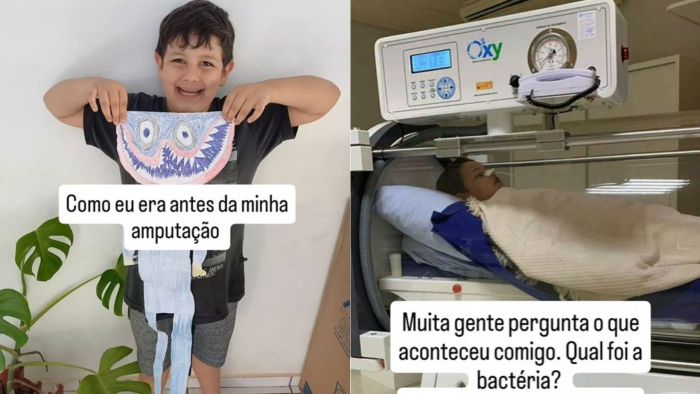 Joseph mostra em suas redes sociais o antes e depois do acidente.