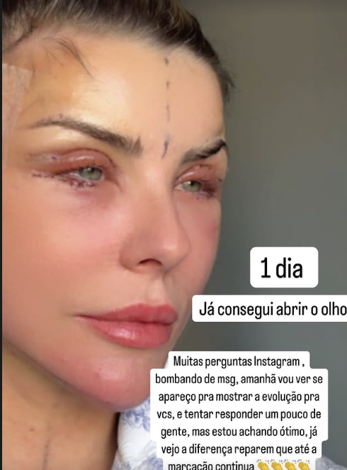 Íris Stefanelli exibe rosto após cirurgia estética 