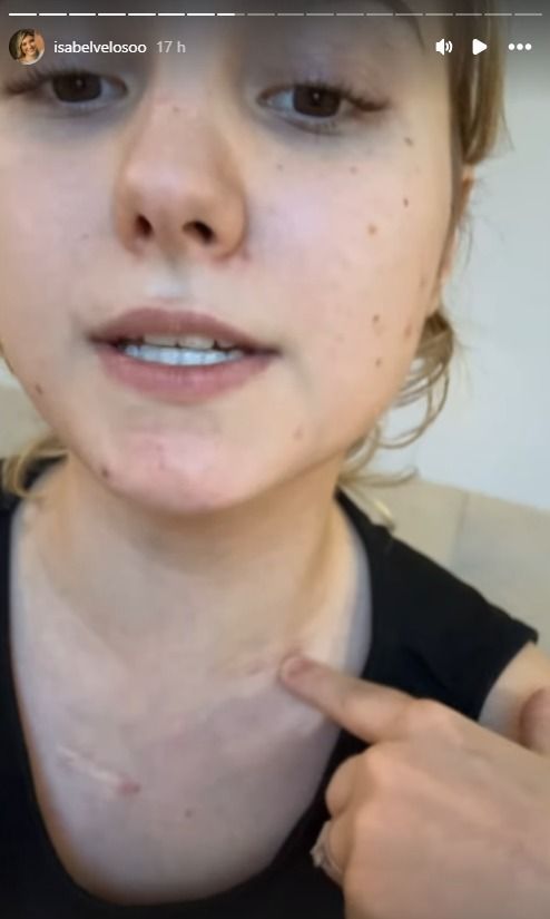 Por fim, Isabel explicou que está bem, mas com o pescoço bem inchado.