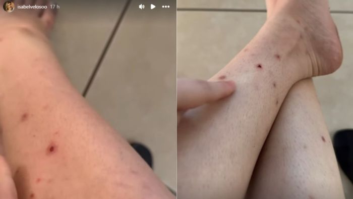 Isabel Veloso, influencer com câncer terminal, fala sobre picadas de pernilongo que não cicatrizam devido à doença.