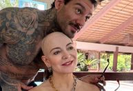 Saiba o que é alopecia, doença que atinge mãe de Lucas Lucco