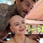 Saiba o que é alopecia, doença que atinge mãe de Lucas Lucco
