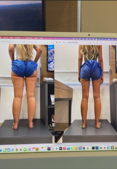 Yasmin Brunet exibe antes e depois 
