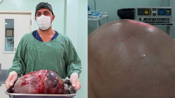 Médico segurando tumor de 15 kg retirado de moradora em Rio das Ostras, no Rio de Janeiro.